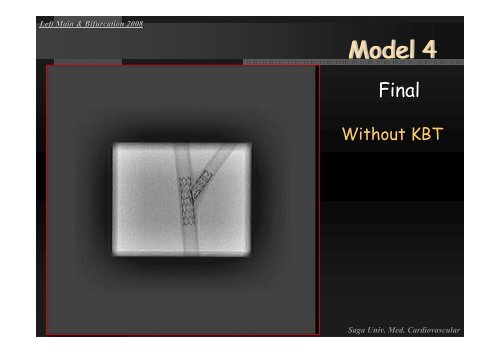 Insight of Various Bifurcation Stenting Techniques ... - summitMD.com