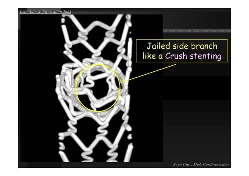 Insight of Various Bifurcation Stenting Techniques ... - summitMD.com