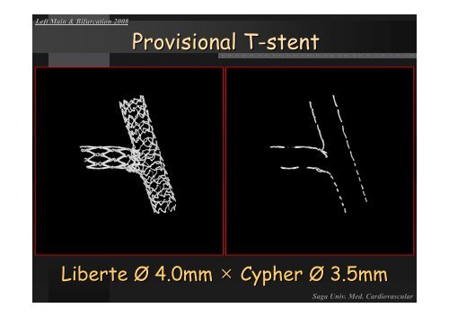 Insight of Various Bifurcation Stenting Techniques ... - summitMD.com