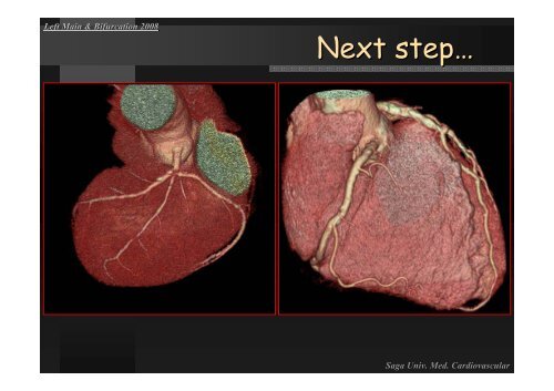 Insight of Various Bifurcation Stenting Techniques ... - summitMD.com