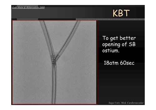 Insight of Various Bifurcation Stenting Techniques ... - summitMD.com