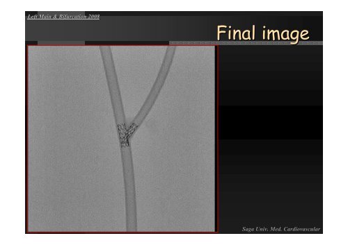 Insight of Various Bifurcation Stenting Techniques ... - summitMD.com