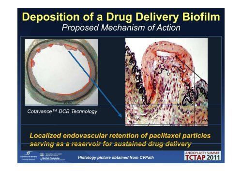 Drug Eluting Balloons will Drug-Eluting Balloons ... - summitMD.com