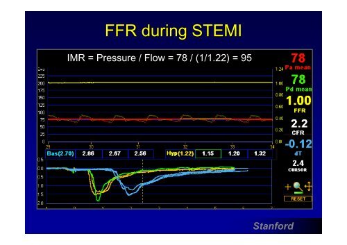 Measuring FFR: Measuring FFR: - summitMD.com