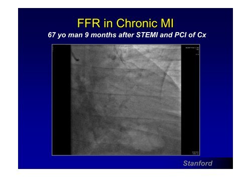 Measuring FFR: Measuring FFR: - summitMD.com