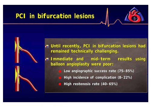 Efficacy of FX Minirail Balloon in Bifurcation Lesions - summitMD.com
