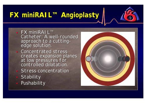 Efficacy of FX Minirail Balloon in Bifurcation Lesions - summitMD.com