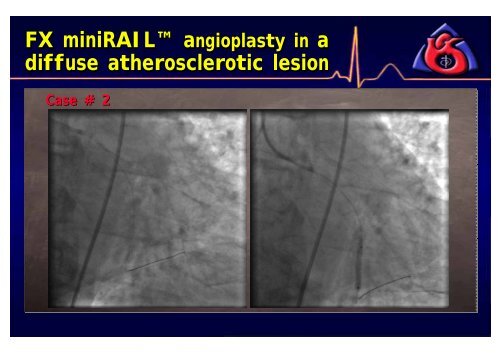 Efficacy of FX Minirail Balloon in Bifurcation Lesions - summitMD.com