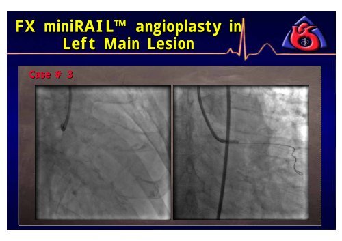 Efficacy of FX Minirail Balloon in Bifurcation Lesions - summitMD.com