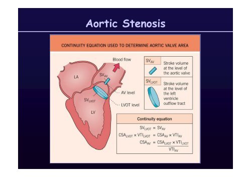 Aortic Stenosis: Aortic Stenosis - summitMD.com