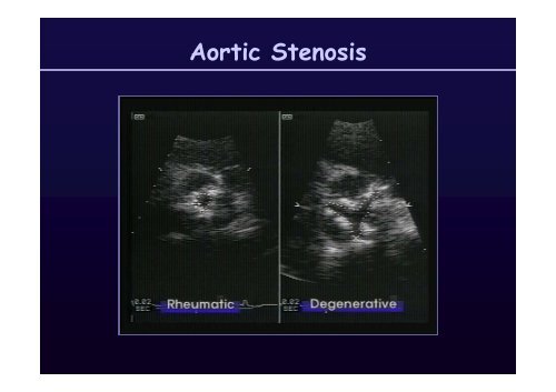 Aortic Stenosis: Aortic Stenosis - summitMD.com