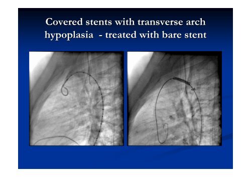 Stenting in coarctation of the aorta- Shall all ... - summitMD.com