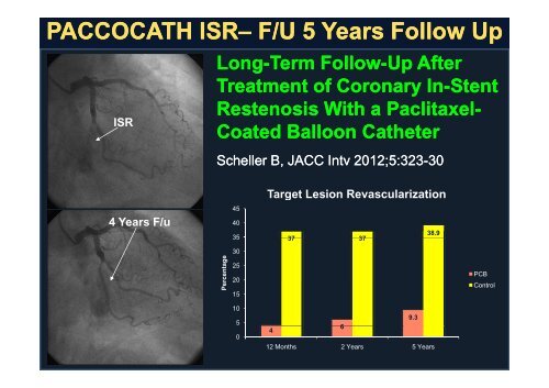 Drug Coated Balloon Drug-Coated Balloon ... - summitMD.com