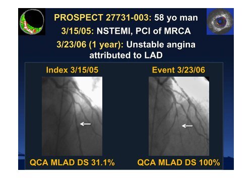 Attenuated Plaque - summitMD.com