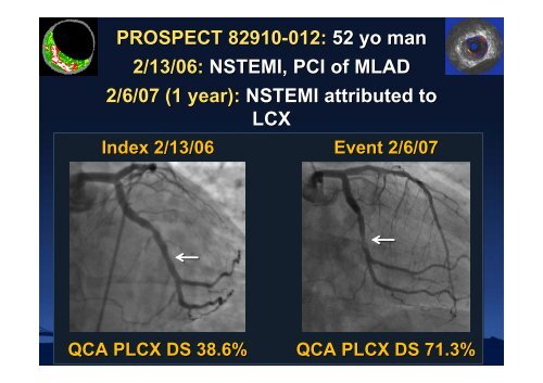 Attenuated Plaque - summitMD.com