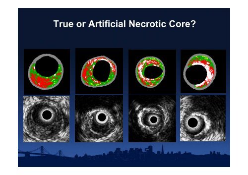 Attenuated Plaque - summitMD.com