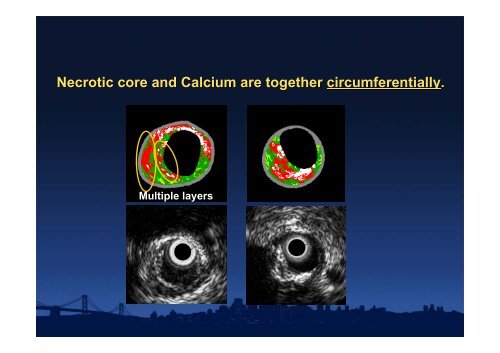 Attenuated Plaque - summitMD.com