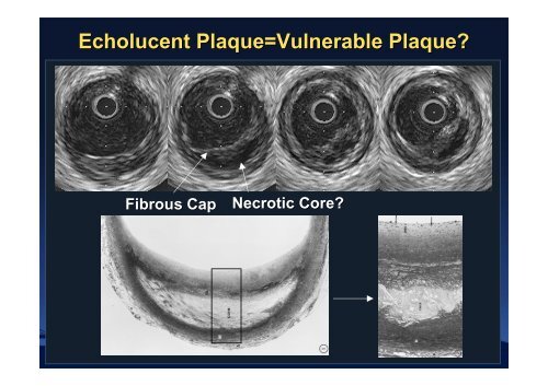 Attenuated Plaque - summitMD.com