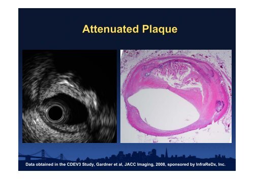 Attenuated Plaque - summitMD.com