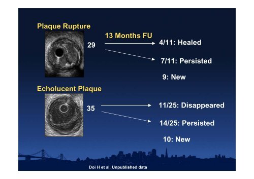 Attenuated Plaque - summitMD.com