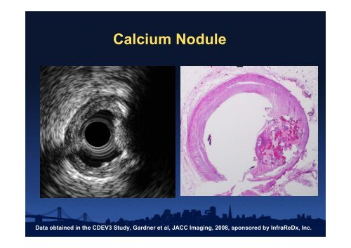 Attenuated Plaque - summitMD.com