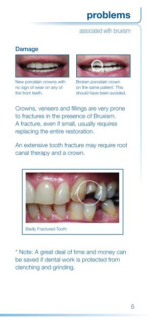 Splint for grinding - Carnegie Dental Group