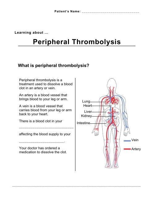 Peripheral Thrombolysis St Joseph S Healthcare Hamilton