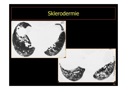 Interstitielle Pneumonie - Diagnostikum Graz