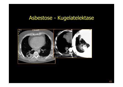 Interstitielle Pneumonie - Diagnostikum Graz