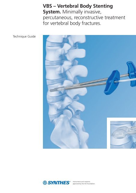 VBS – Vertebral Body Stenting System. Minimally invasive ... - Synthes