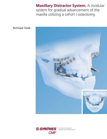 Maxillary Distractor System TG - Synthes