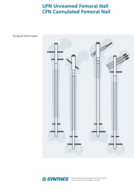Effect of nailing technique on length of stay in isolated ballistic femoral  shaft fractures | European Journal of Orthopaedic Surgery & Traumatology