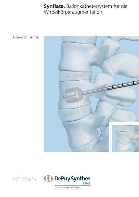 Synflate. Ballonkathetersystem für die ... - Synthes