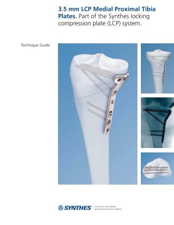 3.5 mm LCP Medial Proximal Tibia Plates Technique Guide - Synthes