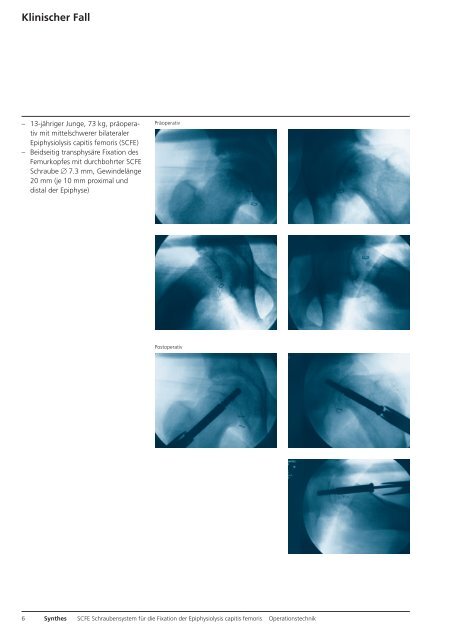 SCFE Schraubensystem für die Fixation der ... - Synthes