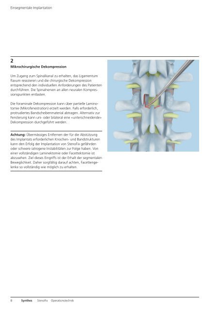 StenoFix. Interspinale Distraktion nach operativer ... - Synthes