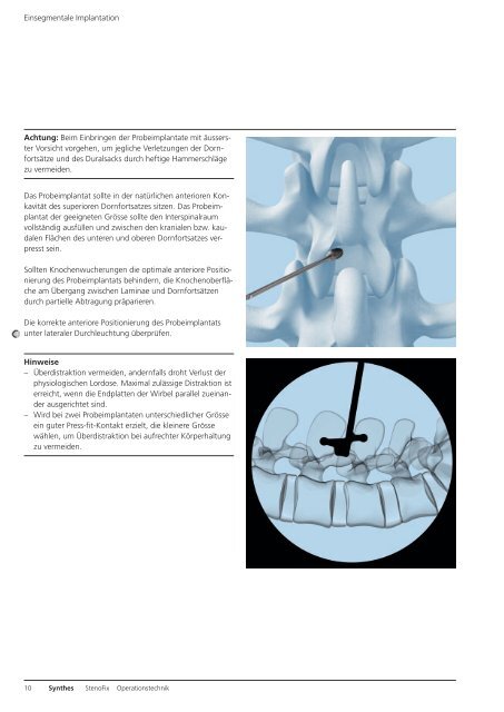 StenoFix. Interspinale Distraktion nach operativer ... - Synthes