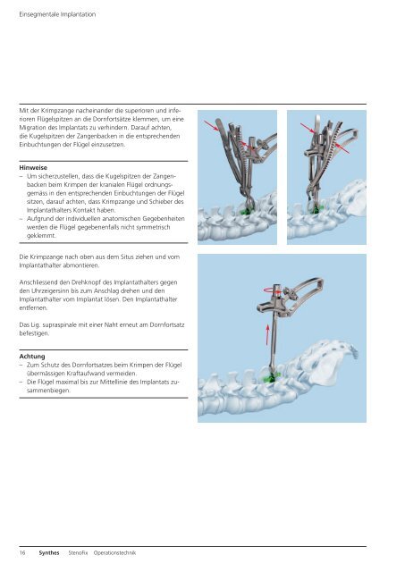 StenoFix. Interspinale Distraktion nach operativer ... - Synthes