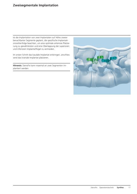 StenoFix. Interspinale Distraktion nach operativer ... - Synthes