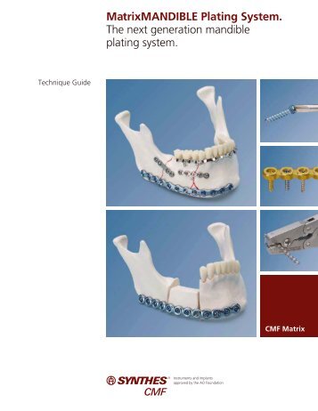 MatrixMANDIBLE Plating System Technique Guide - Synthes