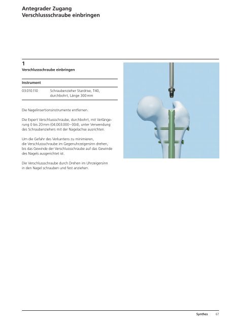 Expert R/AFN. Retrograder / Antegrader Femurnagel. - Synthes