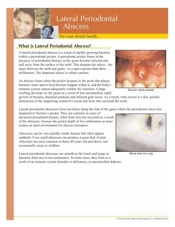 Lateral Periodontal Abscess - Apollonia Dental Center