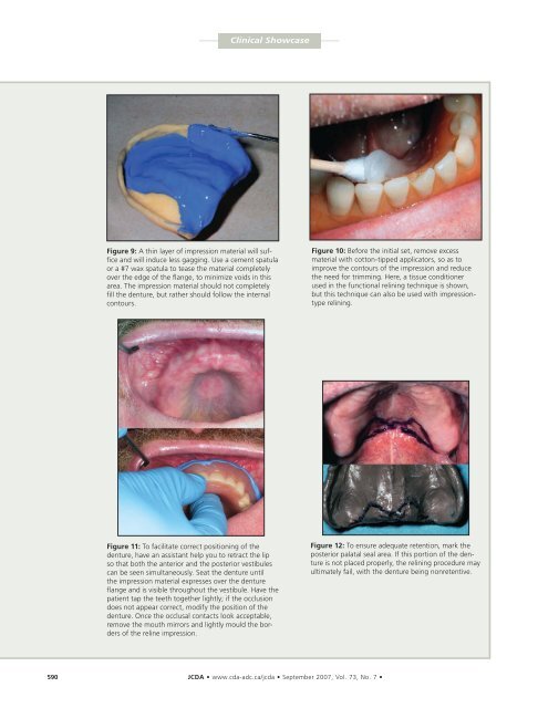 Improving The Outcome Of Denture Relining - Removable ...