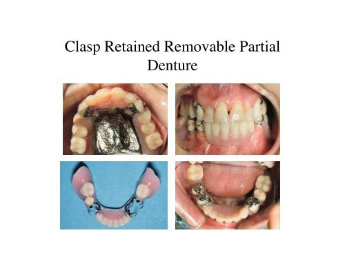 Prosthodontic Treatment Options - Removable Prosthodontics ...