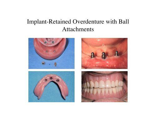 Prosthodontic Treatment Options - Removable Prosthodontics ...