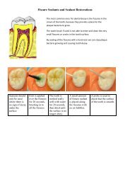 Fissure Sealants and Sealant Restorations