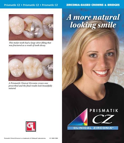 Prismatik CZ Glidewell Dental Labs