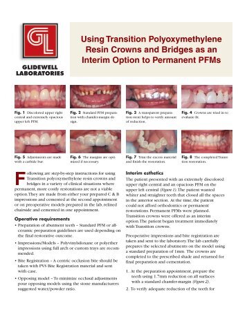 Transition Crown & Bridge Overview - Glidewell Dental Labs