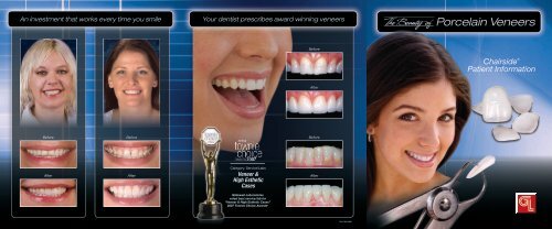 Porcelain Veneers - Glidewell Dental Labs