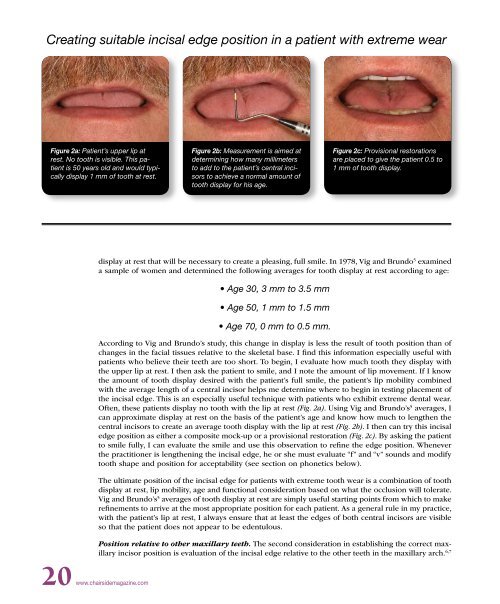 PDF Version - Glidewell Dental Labs